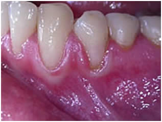 Forms of periodontitis: localized juvenile periodontitis