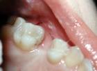 Impacted tooth luxation