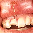 Treatment of patients with dislocation of the tooth