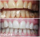 Seven ways to whiten teeth
