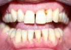 Because of what appears periodontitis?