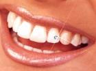Diamonds on teeth