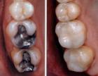 Microprosthetics teeth