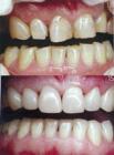 Art restoration of teeth