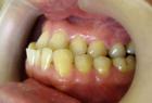 Crooked teeth hurt health