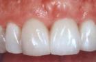 How does the tooth enamel rights?