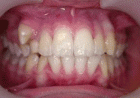 Principles Of Prevention Tooth-jaw Anomalies And Strain