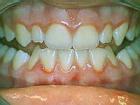 What does the remineralization of enamel teeth?