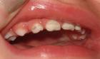Hypoplasia - damage to non-carious teeth.