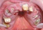 Cure periodontitis may