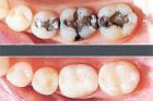 What makes permanent seal on the teeth?