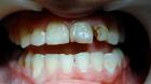 How to prevent caries?