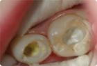 Pulpitis - inflammation of the dental pulp