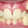 Forms of periodontitis: prepubertal periodontitis