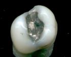 Modern materials for dental fillings